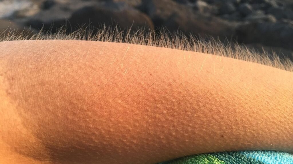 Psychology Says Goosebumps Are a Relic of Our Hairier Ancestors
