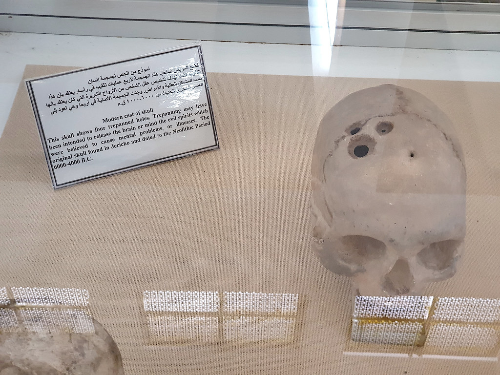 Anthropology Says Evidence of Successful Surgery Exists in Skulls 7,000 Years Old - We Know the Patients Survived Because the Bone Healed Over the Wound