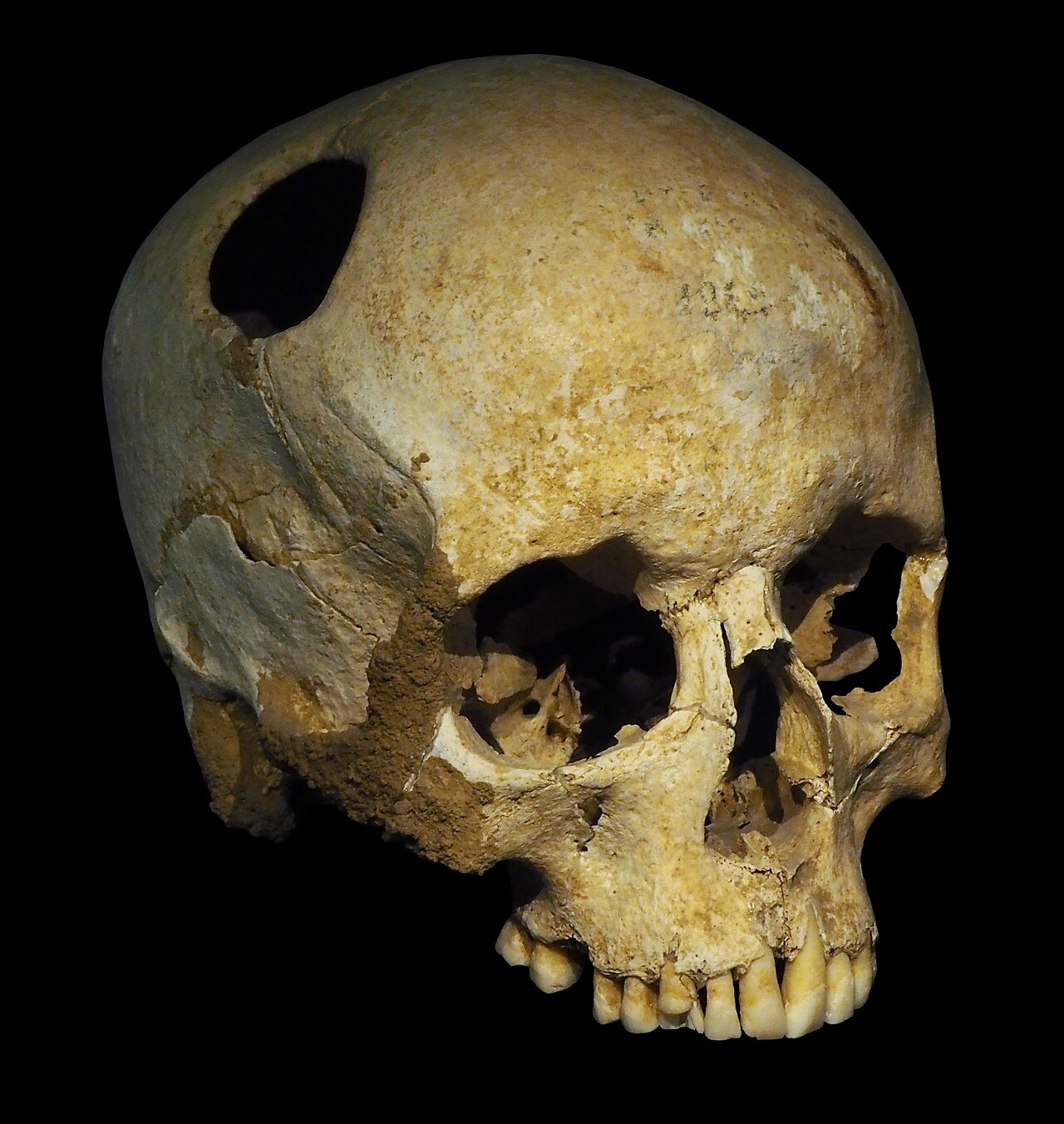 Why These 7,000‑Year‑Old Surgeries Change How We See Human History