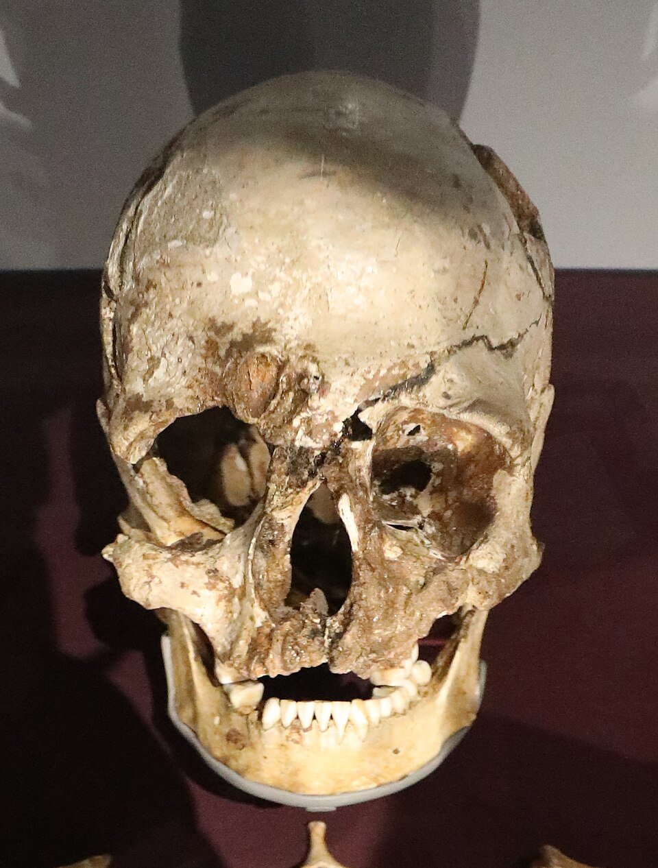 #4 - The Mysterious Hole in His Skull